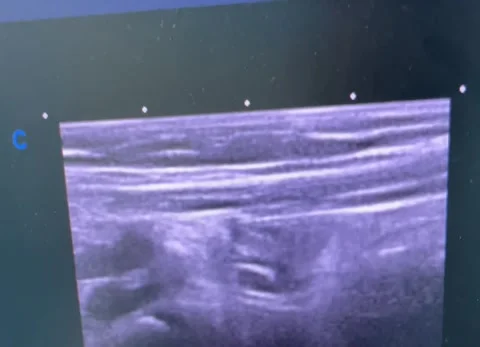 Acute Appendicitis Ultrasound with Changing Appendix Views on a Medical Screen Video stock 288891621