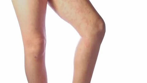 Acute atopic dermatitis on the legs behind the knees of a child is a Stock Footage 201267979