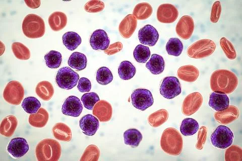 Acute lymphoblastic leukemia, bone marrow smear Stock Illustration