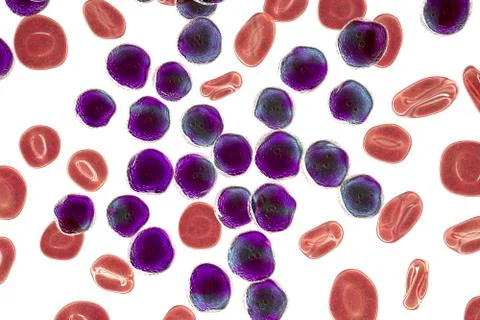 Acute lymphoblastic leukemia, bone marrow smear Stock Illustration