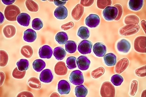 Acute lymphoblastic leukemia, bone marrow smear Stock Illustration