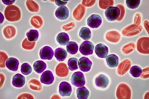 Acute lymphoblastic leukemia, bone marrow smear Stock Illustration
