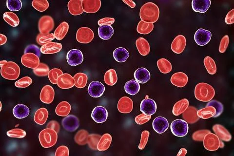 Acute lymphoblastic leukemia Stock Illustration