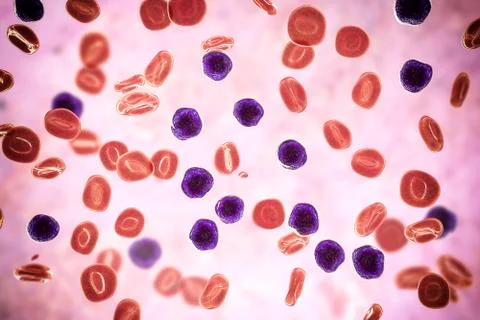 Acute lymphoblastic leukemia Illustrazione stock