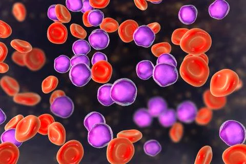 Acute lymphoblastic leukemia Stock Illustration