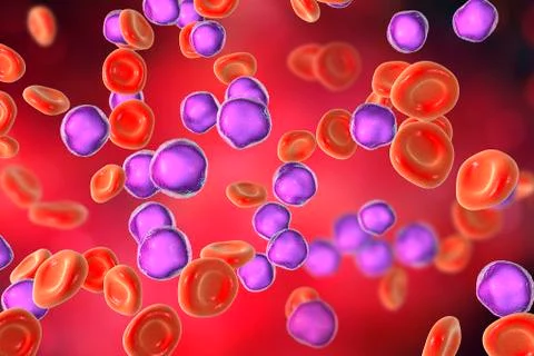 Acute lymphoblastic leukemia Stock Illustration