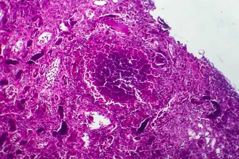 Acute nephritis, light micrograph Stock Photos