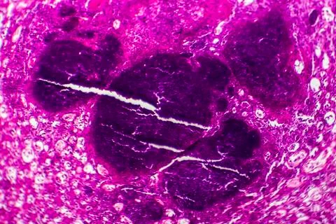 Acute nephritis, light micrograph Stock Photos