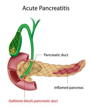 Acute Pancreatitis Stock Illustration