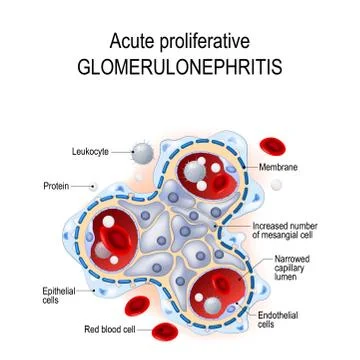 Acute proliferative glomerulonephritis. Stock Illustration