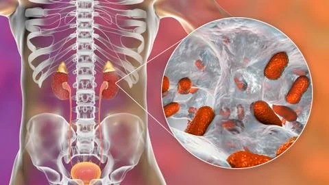 Acute pyelonephritis caused by bacteria Acinetobacter baumannii, medical conc Illustrazione stock
