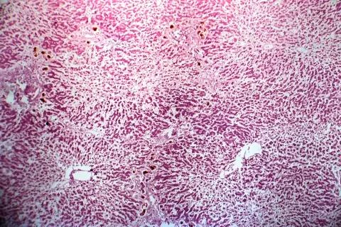 Acute severe hepatitis, light micrograph Stock Photos