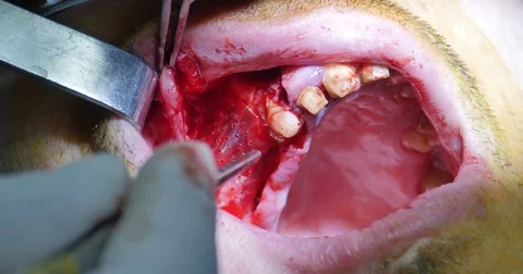 Adding membrane surgery jaw bone Stock Footage 70171017