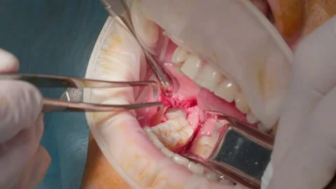 Adding plasma to the gum Stockbeeldmateriaal 157221170