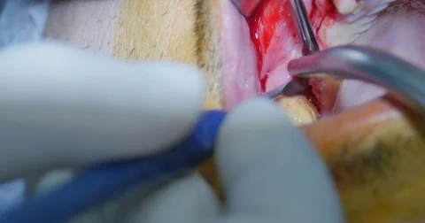 Addition and bone augmentation surgery Stock Footage 70171278