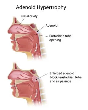 Adenoid hypertrophy Stock Illustration