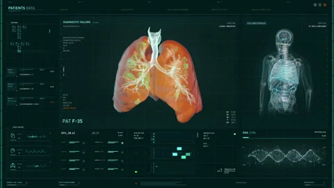 Advanced Computer Program Is Scanning Patient's Lungs For Covid-19 Diagnosis Stock Footage 279835728