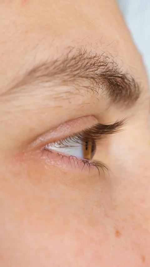 Advanced keratoconus eye disease macro profile view Stock Footage 339615332