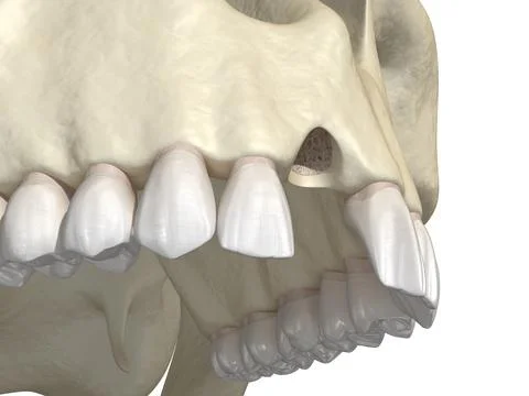 Aesthetic defect after losing central incisor tooth. Illustrazione stock