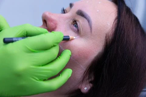 Aesthetic Procedure in Progress: Precise Marking for Cosmetic Enhancement Using Stock Photos