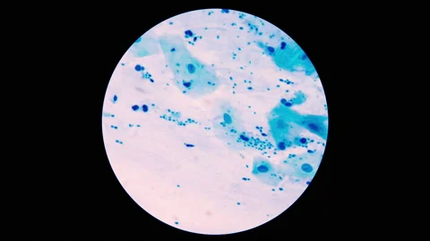 AFB Negative and Positive in stop motion footage. Stock Footage 200409111