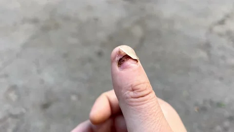 Affected fingernail Stock Footage 202609528