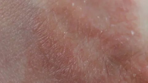 The affected skin is extremely close-up, real time, contains people. Atopic derm Stock Footage 128996790