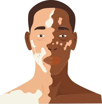 Afro man with vitiligo Stock Illustration