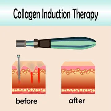 Before after effect, Microneedle stamping device, Collagen induction therapy Stock Illustration