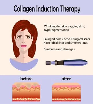Before after effect, Microneedle stamping device, Collagen induction therapy Stock Illustration