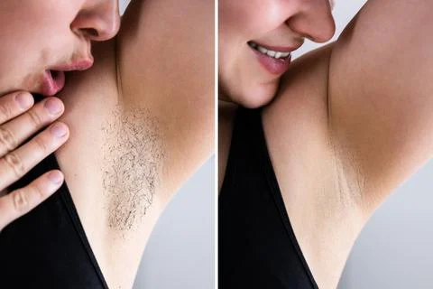 Before After Laser Hair Removal Stock Photos