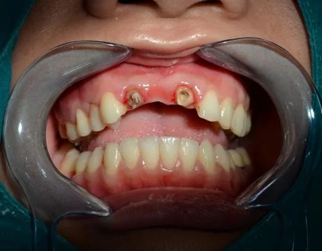 After remove all ceramic bridge of anterior upper teeth Stock Photos