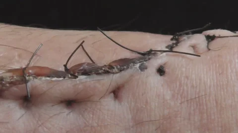 After surgery Video stock 56194373