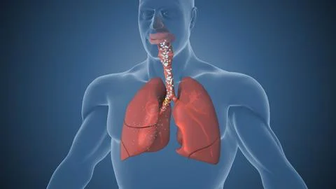 Air Exchange Compromised Due to Collapsed Lung Sections (2) Illustration