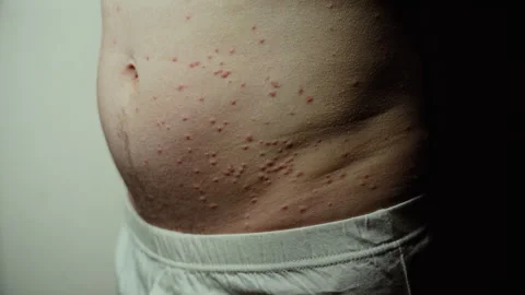Alarming Bumps - Man's Agonizing Itch Raises Questions of Insect Bites or Video stock 244704898