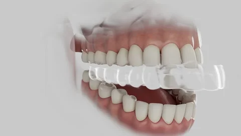 Aligner Stock Footage 316594089