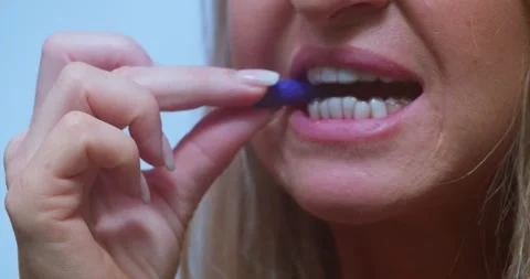 Aligner Placement and Bite Fitting Orthodontic Appliance Close-Up | 12bit braw Stock Footage 314602410