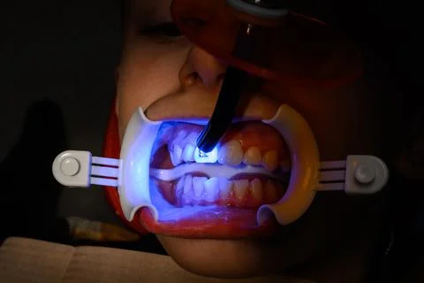 Alignment of crooked teeth with the help of braces, installation of braces fo 스톡 사진