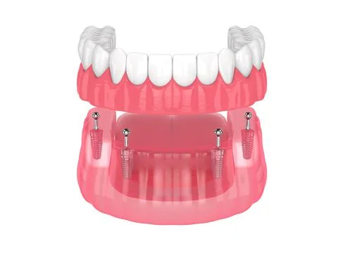 All-on-4 removable, implants supported, overdenture installation Stock Illustration