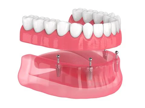 All-on-4 removable, implants supported, overdenture installation Illustrazione stock