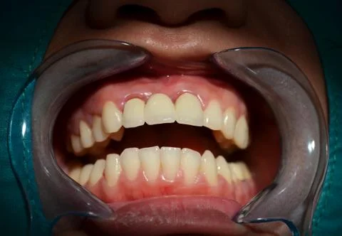 All ceramic bridge of anterior upper teeth Stock Photos