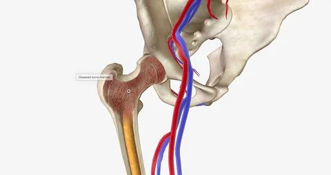 ALL originates in cells in the bone marrow called lymphoblasts Stock Illustration