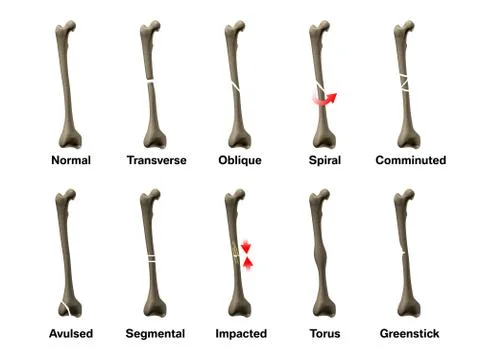 All Types of Bone Fractures Stock Photos