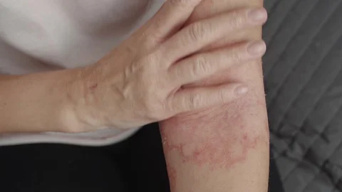 Allergic dermatitis on the arms 動画素材 118643625