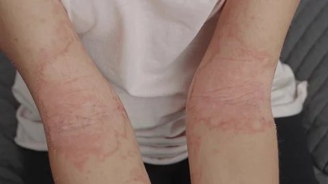Allergic dermatitis on the elbows Video stock 118644587