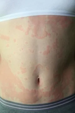 Allergic dermatitis 스톡 사진