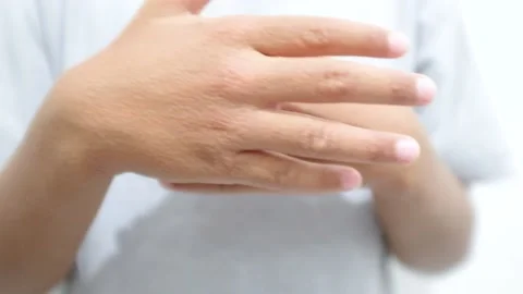 Allergic hand Stock Footage 202135521