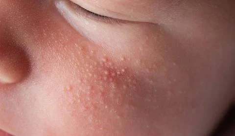 Allergic pimples in a newborn on the face. Pathogenesis, acne of newborns. Stock Photos