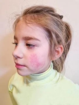 Allergic rash on cheeks in child Stock Photos