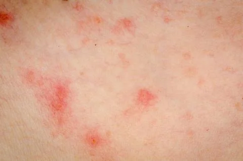 Allergic rash dermatitis eczema skin Stock-Fotos